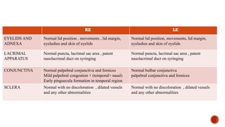 RE LE
EYELIDS AND
ADNEXA
Normal lid position , movements , lid margin,
eyelashes and skin of eyelids
Normal lid position, movements, lid margin,
eyelashes and skin of eyelids
LACRIMAL
APPARATUS
Normal puncta, lacrimal sac area , patent
nasolacrimal duct on syringing
Normal puncta, lacrimal sac area , patent
nasolacrimal duct on syringing
CONJUNCTIVA Normal palpebral conjunctiva and fornices
Mild palpebral congestion + (temporal> nasal)
Early pinguecula formation in temporal region
Normal bulbar conjunctiva
palpebral conjunctiva and fornices
SCLERA Normal with no discoloration , dilated vessels
and any other abnormalities
Normal with no discoloration , dilated vessels
and any other abnormalities
 