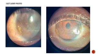 SLIT LAMP PHOTO
 