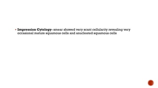 § Impression Cytology- smear showed very scant cellularity revealing very
occasional mature squamous cells and anucleated squamous cells
 