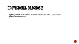 § Right eye OSSN with corneal involvement with preexisting spheroidal
degeneration of cornea
 
