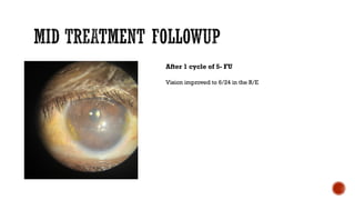 After 1 cycle of 5- FU
Vision improved to 6/24 in the R/E
 