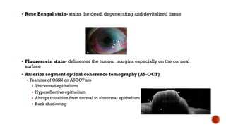 § Rose Bengal stain- stains the dead, degenerating and devitalized tissue
§ Fluorescein stain- delineates the tumour margins especially on the corneal
surface
§ Anterior segment optical coherence tomography (AS-OCT)
§ Features of OSSN on ASOCT are
§ Thickened epithelium
§ Hypereflective epithelium
§ Abrupt transition from normal to abnormal epithelium
§ Back shadowing
 