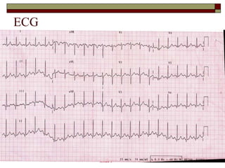 ECG 