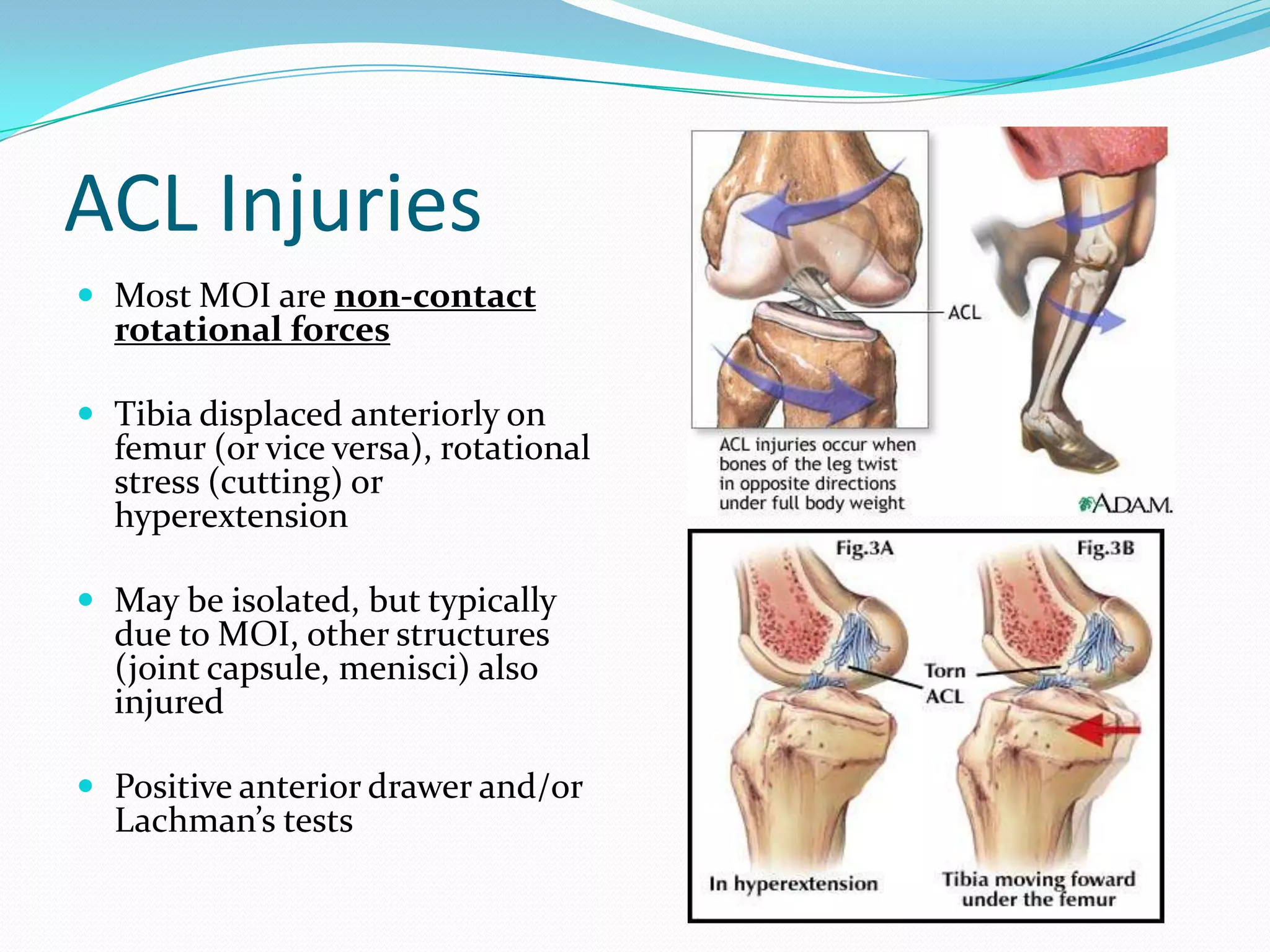 ACL tear | PPTX
