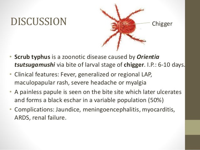 typhus fever