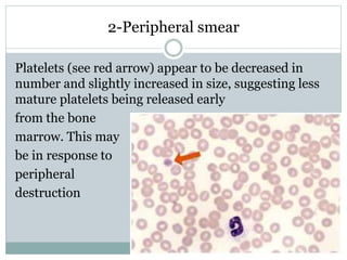 2-Peripheral smear
Platelets (see red arrow) appear to be decreased in
number and slightly increased in size, suggesting less
mature platelets being released early
from the bone
marrow. This may
be in response to
peripheral
destruction
 