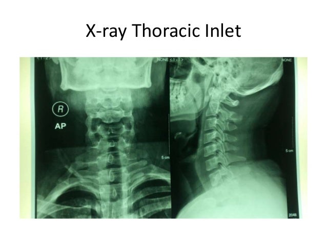 Thoracic Outlet Syndrome