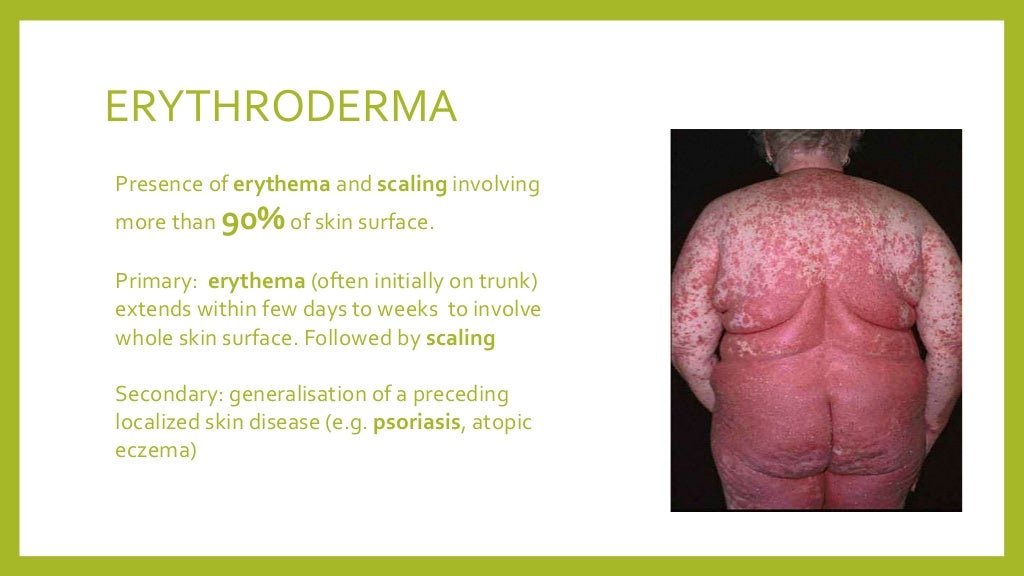 Case presentation in Dermatology erythrodermic psoriasis