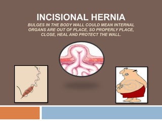 INCISIONAL HERNIA
BULGES IN THE BODY WALL COULD MEAN INTERNAL
ORGANS ARE OUT OF PLACE, SO PROPERLY PLACE,
CLOSE, HEAL AND PROTECT THE WALL.
 