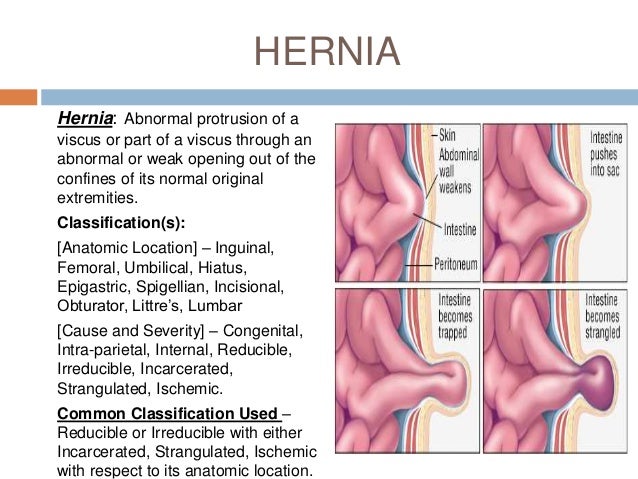 incarcerated hernia