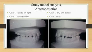 Study model analysis
Anteroposterior
• Class II canine on right
• Class II ½ unit molar
• Class II 1/2 unit canine
• Class I molar
 