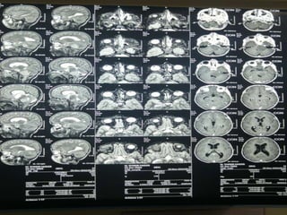 Sixth Nerve Palsy | PPTX