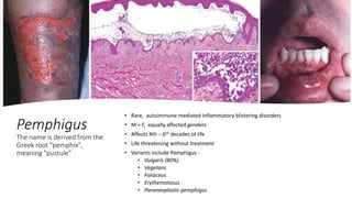 Pemphigus
The name is derived from the
Greek root "pemphix",
meaning "pustule”
• Rare, autoimmune mediated inflammatory blistering disorders
• M = F, equally affected genders
• Affects 4th – 6th decades of life
• Life threatening without treatment
• Variants include Pemphigus -
• Vulgaris (80%)
• Vegetans
• Foliaceus
• Erythematosus
• Paraneoplastic pemphigus
 