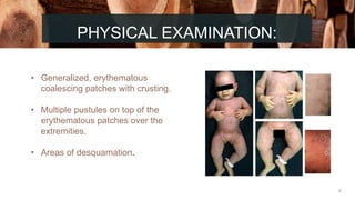 Coalescent Rash CASE PRESENTATION.pptx