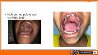 Jens Martensson
• high arched palate and
crowded teeth
12
 