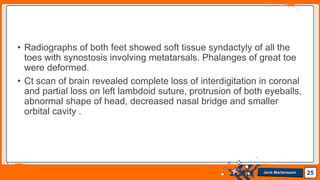 Jens Martensson
• Radiographs of both feet showed soft tissue syndactyly of all the
toes with synostosis involving metatarsals. Phalanges of great toe
were deformed.
• Ct scan of brain revealed complete loss of interdigitation in coronal
and partial loss on left lambdoid suture, protrusion of both eyeballs,
abnormal shape of head, decreased nasal bridge and smaller
orbital cavity .
25
 