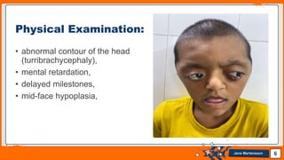 Jens Martensson
• abnormal contour of the head
(turribrachycephaly),
• mental retardation,
• delayed milestones,
• mid-face hypoplasia,
6
Physical Examination:
 