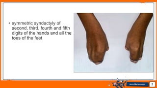 Jens Martensson
• symmetric syndactyly of
second, third, fourth and fifth
digits of the hands and all the
toes of the feet
7
 