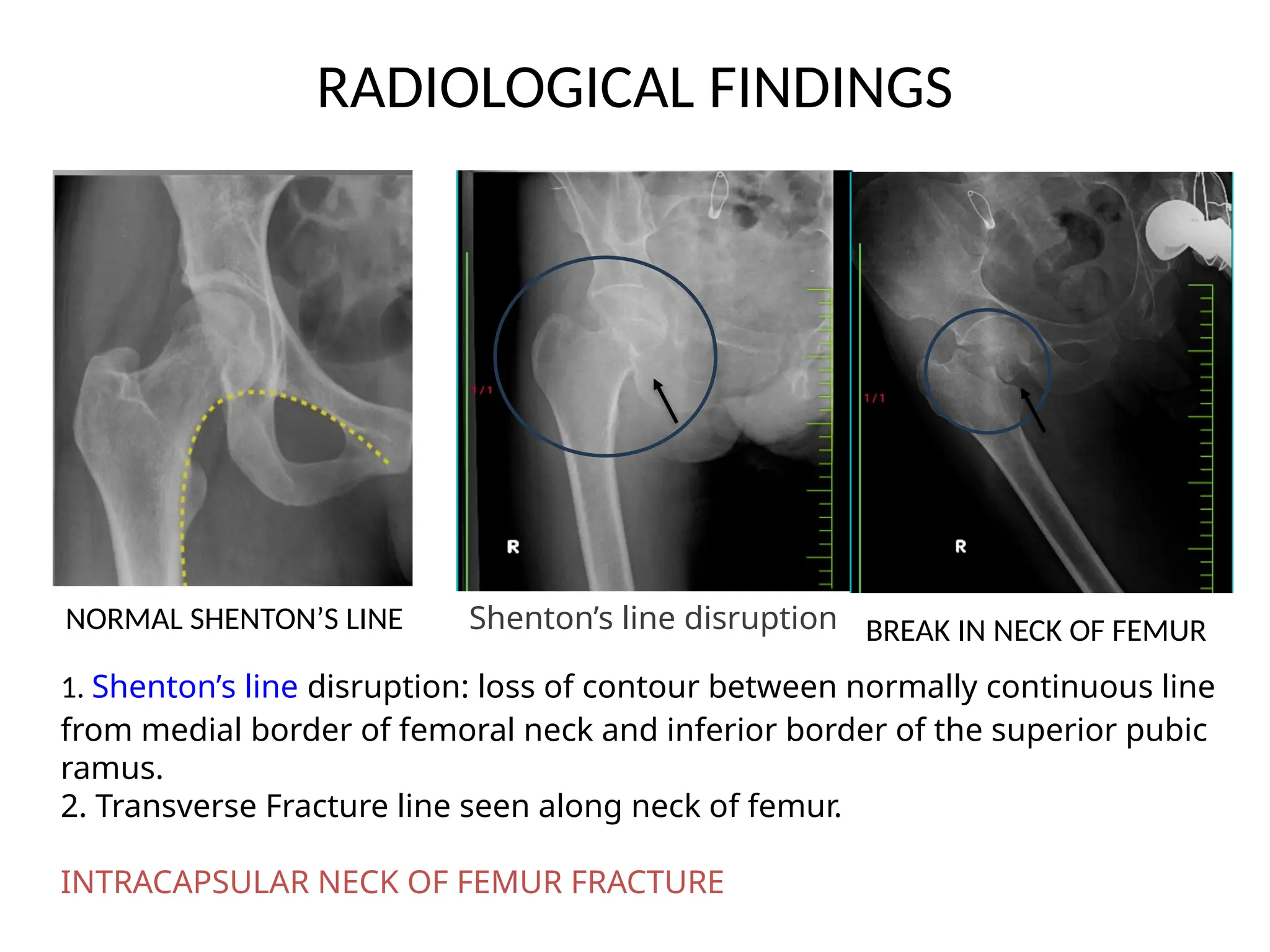 Stenton Line Case presentation.pptxneck of femur fracture without dnvd | PPTX