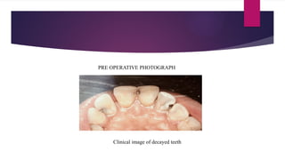 CASE PRESENTATION for restoration with giomer | PPTX