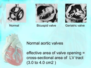 Aortic Stenosis: Physical Findings
S1 S2 S1
S2
Mild-Moderate Severe
An early peaking murmur is typical for mild to moderat...