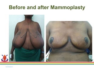 5/23/2023
Before and after Mammoplasty
 