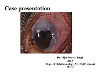 Case presentation
Dr. Vijay Pratap Singh
JR-3
Dept. of Ophthalmology, MLBMC, Jhansi
(U.P.)
 