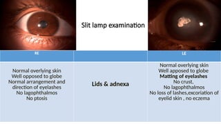 Case Presentation - Pigmented Fungal Corneal Ulcer | PPTX