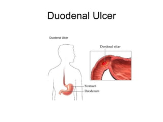 Duodenal Ulcer Duodenal Ulcer  