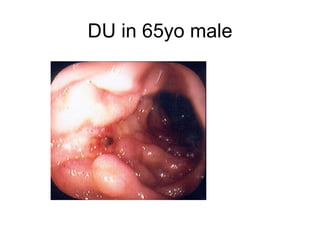 DU in 65yo male 