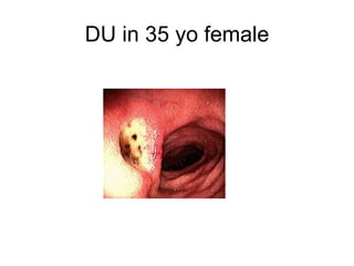 DU in 35 yo female 