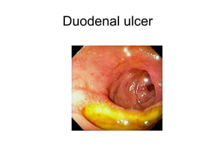 Duodenal ulcer  