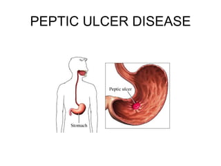 PEPTIC ULCER DISEASE 