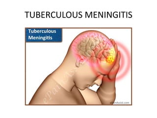 TUBERCULOUS MENINGITIS
 