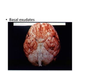 • Basal exudates
 