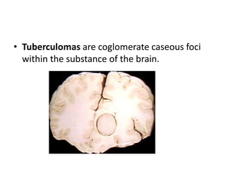 • Tuberculomas are coglomerate caseous foci
within the substance of the brain.
 