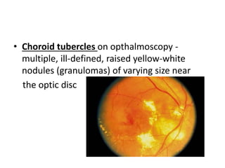 • Choroid tubercles on opthalmoscopy -
multiple, ill-defined, raised yellow-white
nodules (granulomas) of varying size near
the optic disc
 