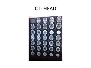 CT- HEAD
 