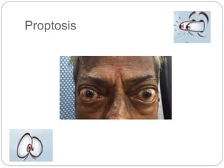 Proptosis
 