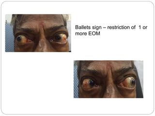 Ballets sign – restriction of 1 or
more EOM
 