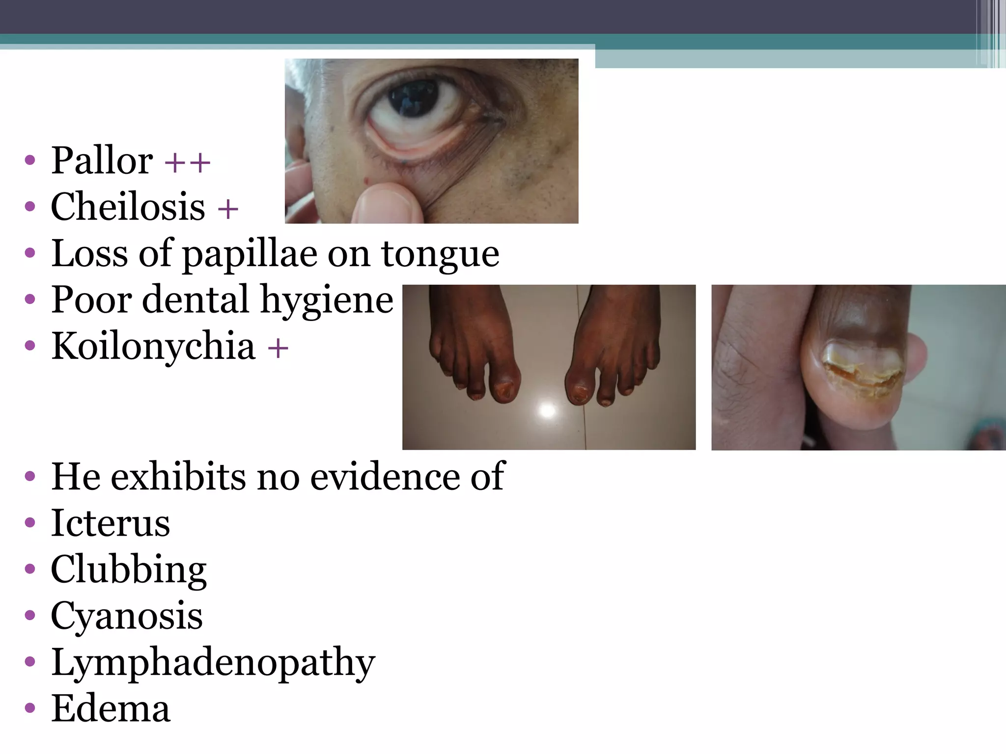 • Pallor ++
• Cheilosis +
• Loss of papillae on tongue
• Poor dental hygiene
• Koilonychia +
• He exhibits no evidence of
• Icterus
• Clubbing
• Cyanosis
• Lymphadenopathy
• Edema
 
