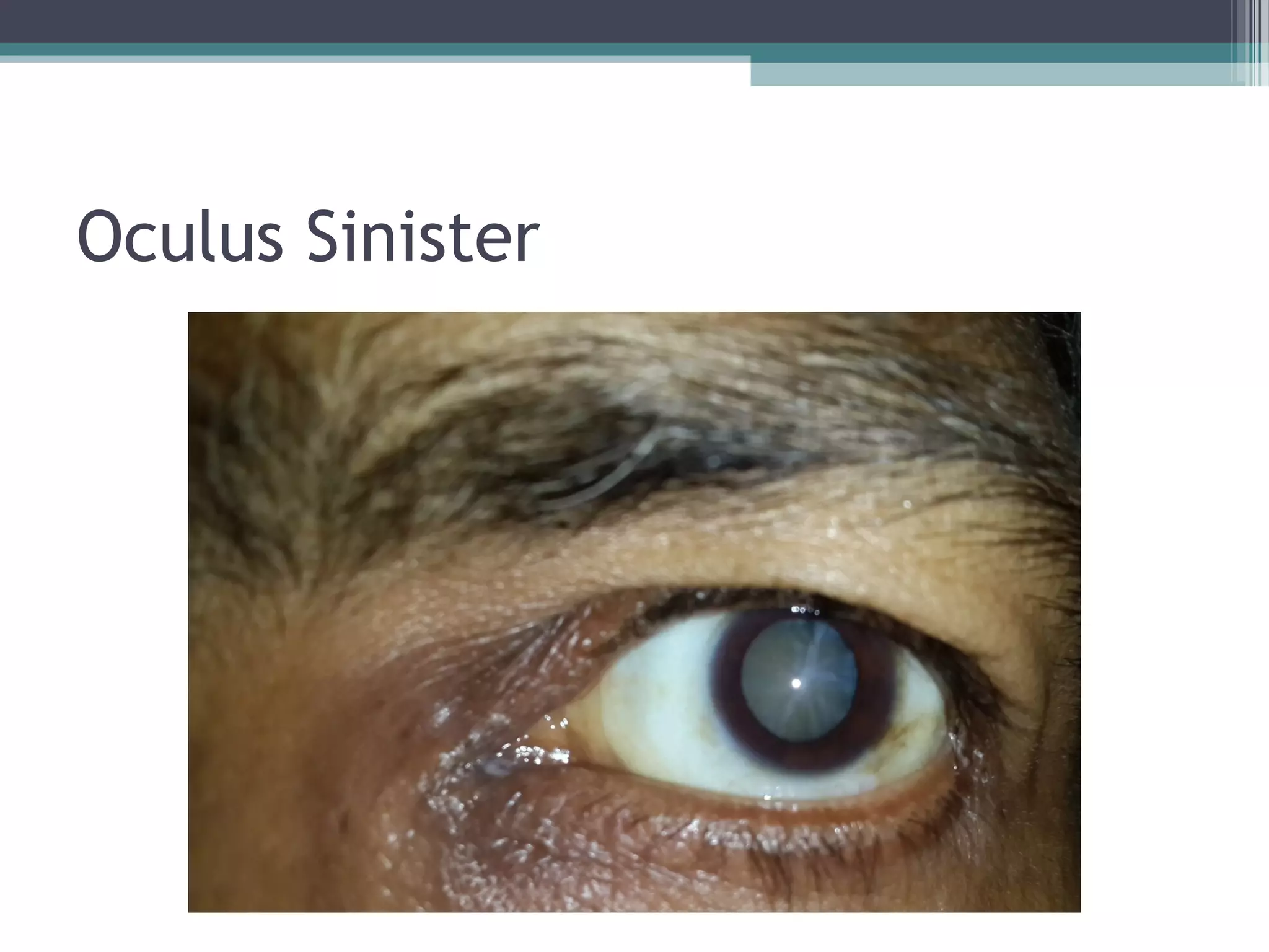 Oculus Sinister 
 