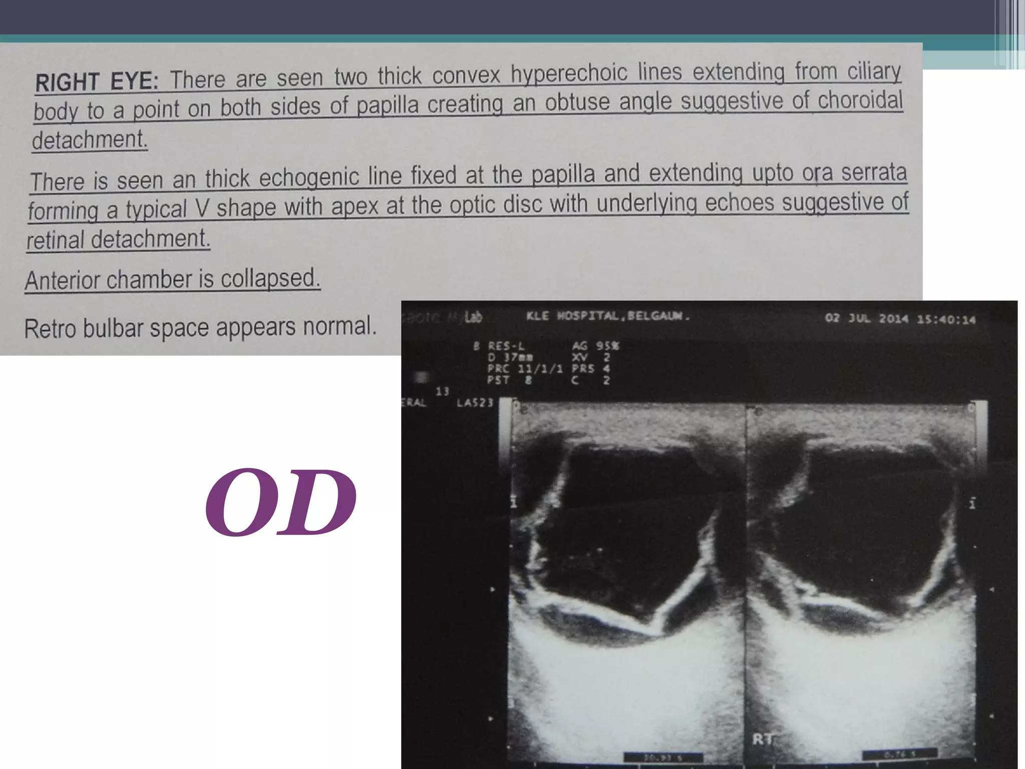 B- Scan Ultrasonography
OD
 