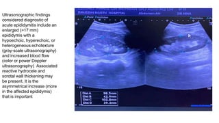 Ultrasonographic findings
considered diagnostic of
acute epididymitis include an
enlarged (>17 mm)
epididymis with a
hypoechoic, hyperechoic, or
heterogeneous echotexture
(gray-scale ultrasonography)
and increased blood flow
(color or power Doppler
ultrasonography) Associated
reactive hydrocele and
scrotal wall thickening may
be present. It is the
asymmetrical increase (more
in the affected epididymis)
that is important
 