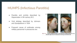MUMPS (Infectious Parotitis)
● Parotitis and orchitis described by
Hippocrates in 5th century B.C.
● Viral etiology described by Johnson
and Goodpasture in 1934
● Frequent cause of outbreaks among
military personnel in prevaccine era
 