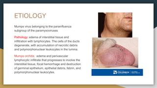 ETIOLOGY
Mumps virus belonging to the parainfluenza
subgroup of the paramyxoviruses
Pathology: edema of interstitial tissue and
infiltration with lymphocytes. The cells of the ducts
degenerate, with accumulation of necrotic debris
and polymorphonuclear leukocytes in the lumina.
Mumps orchitis: edema and perivascular
lymphocytic infiltrate that progresses to involve the
interstitial tissue, focal hemorrhage and destruction
of germinal epithelium, epithelial debris, febrin, and
polymorphonuclear leukocytes.
 