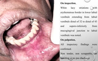 Examination of lesion
On inspection
On inspection,
White lacy striations with
erythematous border in lower labial
vestibule extending from labial
vestibule distal of 32 to distal of 43
and supero-inferiorly from
mucogingival junction to labial
vestibule was noted.
On palpation,
All inspectory findings were
confirmed.
Non tender, non scrappable, no
bleeding or no pus discharge
 