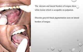 The dorsum and lateral borders of tongue show
white lesion which is scrapable on palpation.
Discrete greyish black pigmentation seen on lateral
borders of tongue.
 