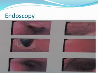 Endoscopy