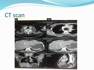 CT scan